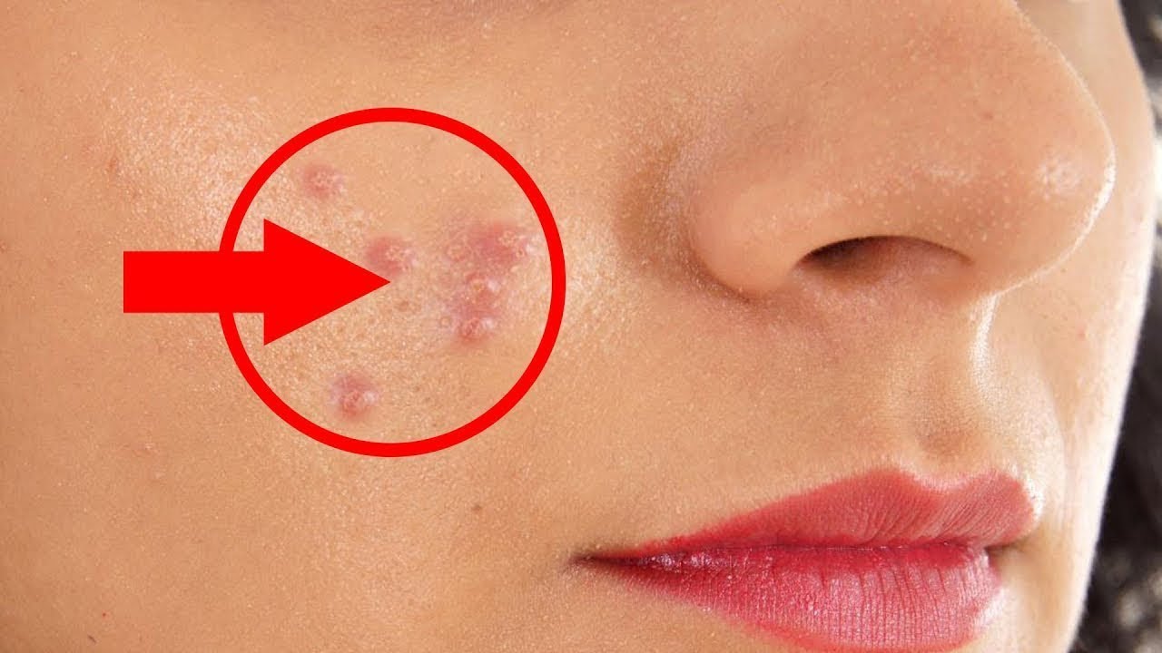 How to Remove Pimples Overnight | Beauty Tips in Tamil