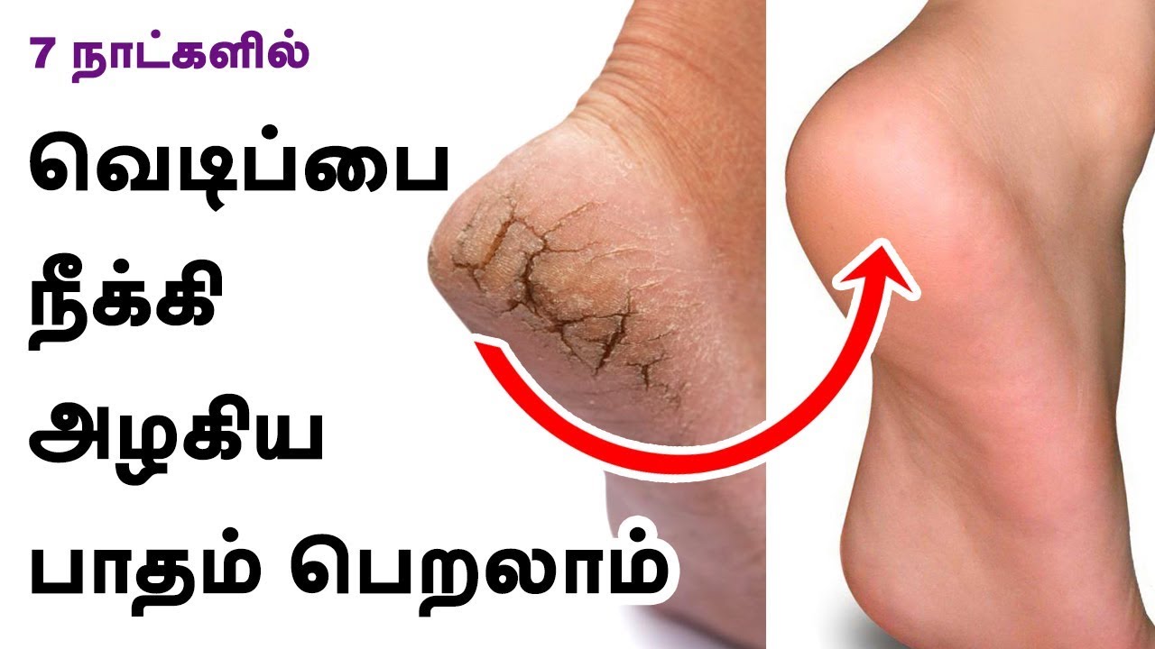 Cracked Heels Remedy – How To Treat Cracked Heels? – Beauty Tips in Tamil