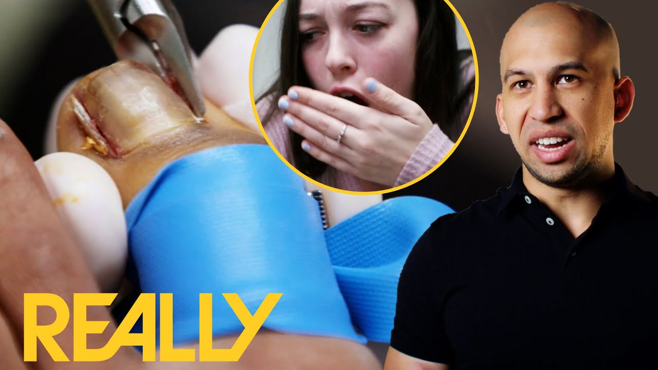 Massive Ingrown Nails Are Keeping This Dancer Away From Her Passion | The Toe Bro