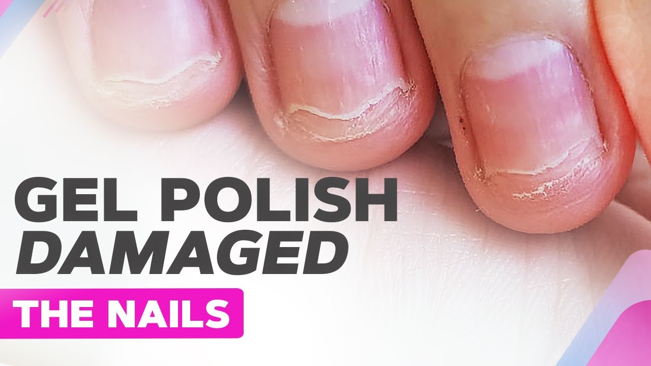 Badly Damaged Nails | Gel Polish Allergy, Nail Plate Burn, Onycholysis