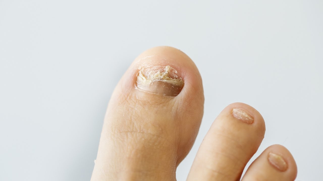 How to prevent and treat nail fungus