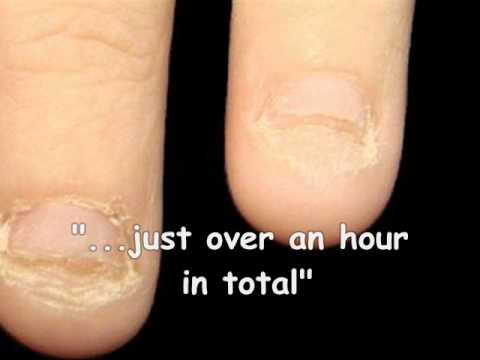 Inverted Moulds Extreme ‘Bitten Nails’